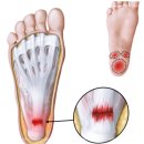 중앙U병원 | 족저근막염 완치 깔창 내돈내산 후기