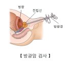 방광암, 신장암이란 이미지