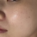 영양종합장식 | [서면여드름관리] 이마 모낭염과 극심한 속건조, 서면에스테틱 비오엘 시그니처 밸런스케어