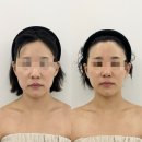 동수5길 | 충주 윤곽관리 &#39;아이로사&#39; 솔직후기👉 얼굴라인 관리 받고 왔음. 샵 후기 + 예약방법 총정리