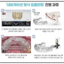 덴티캠치과기공소 | 춘천치과 앞니 발치 즉시 디지털 임플란트 식립 후기