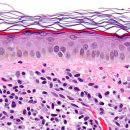 Mastocytosis세포증식증 이미지