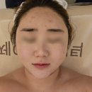 문성 제이에스테틱에서 바늘 없는 MTS 샤인 스탬프 받고 온 후기