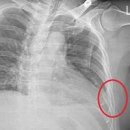 갈비뼈 금갔을때 증상 및 치료 : 늑골 골절 이미지