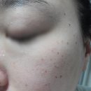 두근두근한의원 | [포메디한의원] 인천 구월동 기미 주근깨 잡티 제거 토닝레이저 내돈내산 통증 주의사항 딱지 전후...