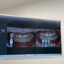 미백 | 예신 필수 관리 ! 강남 원데이치아미백 내돈내산 후기🤍