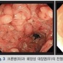궤양성 대장염 초기증상 계속설사할때 원인 이미지