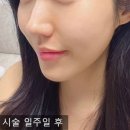 광주메디컬유통 | 광주리쥬란힐러 건조했던 피부 개선했어요!
