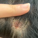 달약국 | 니조랄샴푸 약국 구매 후 한달 써본 솔직후기