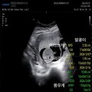 알콩이달콩이 | 쌍둥이 임신 16주 정밀초음파 후기, 기형선별검사, 성별확인, 신경관결손검사 그리고 양수검사 전 검사기록