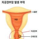 백신으로 예방가능한 최초이자 유일한 암, 자궁경부암 이미지