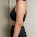 케이멍 | 지방흡입 후 멍관리로 케이베리어 부르즈크림 써봤어요
