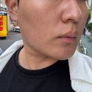 남산타워뷰 신사동피부과 남자 티타늄리프팅 6만줄 후기