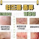 좁쌀 붉은 화농성 결절성 여드름 종류 & 여드름 항생제, .압출 이미지