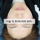 중앙의원 | 기미·점 제거 후기｜말은 잘 듣자,시술 후 일주일 후기(마산,봉암중앙의원)