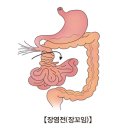 장폐색(Intestinal obstruction) 이미지