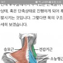 3일 연속으로 왼쪽 뒷머리 통증(뒷목) 이미지