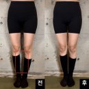 김해더리햅 | 오다리 교정, 실제로 효과가 있을까? (프리미엄 리햅 오다리 교정운동법 실제 전후비교)