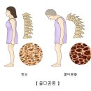 유방 내분비 질환 골다공증 (Osteoporosis) 이란? 이미지