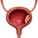 방광암 환자 10년새 45%↑…"5대 예방수칙 알아둬야" 이미지