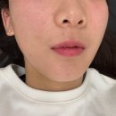 광주 피부과에서 엑소라인 리파인 받은 후기
