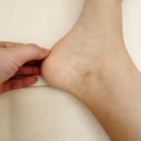 더탄탄병원 | 근저족막염 관리 성공한 후기 (병원납품깔창)