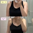 우째이런일이 | [예신 팔뚝 람스 내돈내산 후기] 무한람스 당일~3일차 통증·멍·붓기·가격