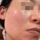 넘버원닥터 | 여드름피부 수분크림 넘버원템 후기 수부지 지성 타입이면 강추