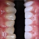 연세라곰치과의원 | 아래앞니 라미네이트도 무삭제로 가능한가요? 레브네이트 베이직 가격/비용/후기/추천.