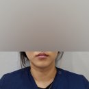래인의원 | 명동피부과 입술필러, 입꼬리 보톡스 받고 온 후기