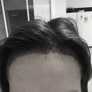 3800 | 여자 M자 헤어라인 비절개 모발이식 3800모 1일차 후기 내돈내산