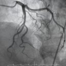 CAG, coronary angiography 이미지