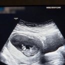 미래통합의원 | 수지 상현동 서브산부인과 결정! / 수지미래 산부인과 1차 기형아검사 후기