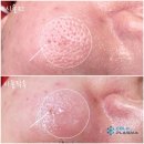 콜드플라즈마 이미지