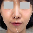 [안면 비대칭/ 턱관절장애] 청담동 한의원에서 ‘침도요법’ 받고 찐 만족한 후기