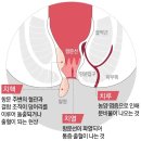 항문질환중 가장 후드러패고싶은놈 이미지