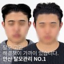 어드반SMP | 안산두피관리 어드반: 섬세한 기술력으로 완성하는 맞춤형 두피 커버 시술!