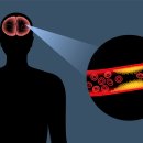 뇌혈관 막힌 &#39;뇌경색&#39; 건강보험 진료비 30% 급증 이미지