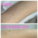 빽다방상도e편한점 | [일산 원톤스킨] SKIN52 특허 기술 흉터커버 1회차 솔직후기