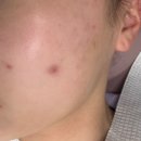 청두곶3길 11 | 사당피부관리실 [스킨리알] 여드름맞춤케어 | 물방울 초음파관리