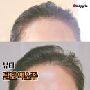 동원병원 | 강남 탈모치료 병원에서 받은 탈모엑소좀 후기 | 궁금증 정리