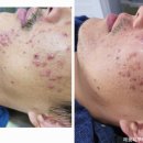 동탄다은마을우남퍼스트빌 10대 남학생 여드름관리