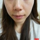 안명문구 | 잡티제거를 위한 셀렉 ipl 받고 왔어요~(이수역 연세마이뷰 피부과.기미.잡티.여드름)