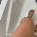 2도 화상 흉터 회복 과정 치료 응급처치 (사진주의!)
