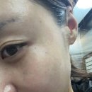 별내약국 | [남양주별내피부과]스킨부스터 콜라겐주사후기/겨울맞이 뷰티데이