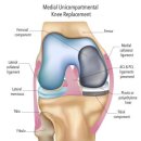 UKA Uni knee 이미지
