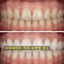 라이프치과기공소 | 라미네이트 시술 과정 및 장기적인 유지관리 비결