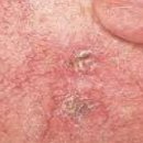 광선각화증 (Actinic Keratosis) 이미지