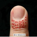 사혈요법 - 뇌졸중엔 양손 A33번에서 사혈로 응급처치 이미지