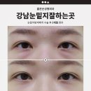 옳은손성형외과의원 | 강남눈밑지잘하는곳, 재발 없는 눈밑 개선 기준은